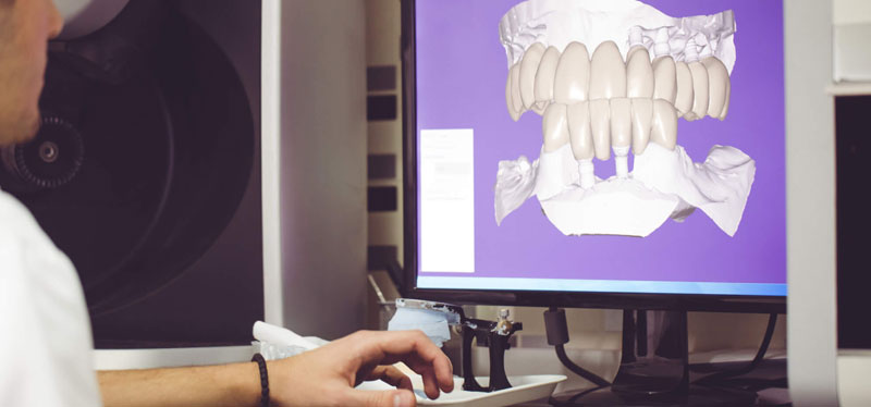 modellazione computerizzata di protesi dentali